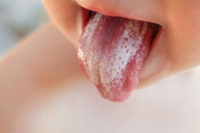 Micose de pele: sintomas, 8 tipos e como tratar (com fotos)-radardasaude 2 Candidíase oral na língua