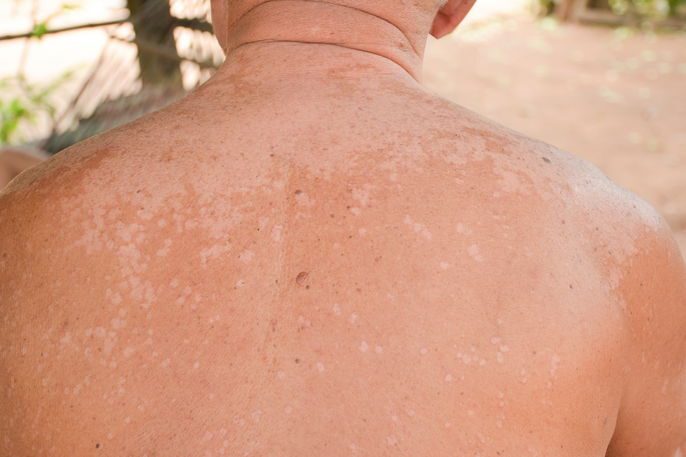 Micose de pele: sintomas, 8 tipos e como tratar (com fotos)-radardasaude 3 Manchas brancas nas costas, características da pitiríase versicolor