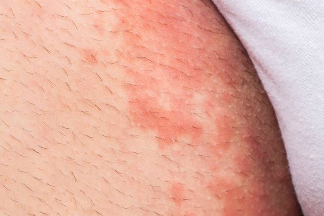 Micose de pele: sintomas, 8 tipos e como tratar (com fotos)-radardasaude 5 Manchas vermelhas na virilha