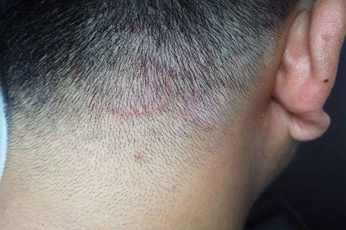 Micose de pele: sintomas, 8 tipos e como tratar (com fotos)-radardasaude 6 Placas vermelhas no couro cabeludo causada pela micose no couro cabeludo