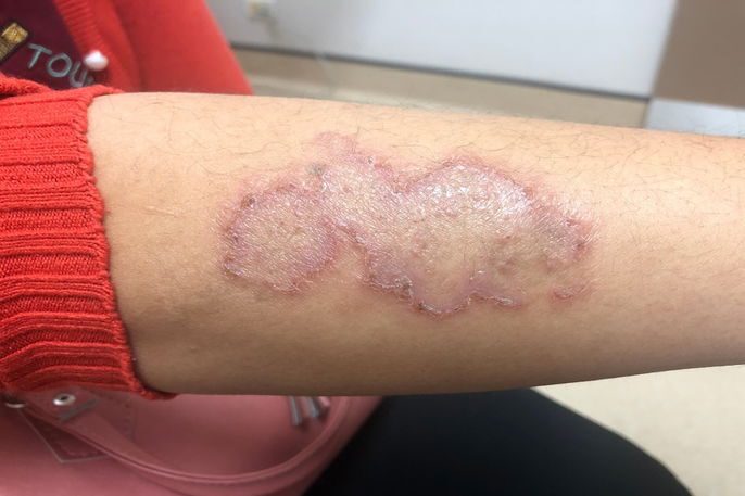 Micose de pele: sintomas, 8 tipos e como tratar (com fotos)-radardasaude 7 Lesão avermelhada no braço característica da impingem ou tinea corporis