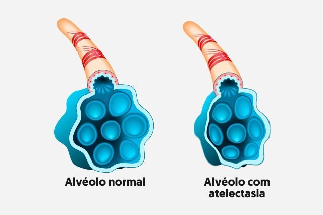 Atelectasia pulmonar: o que é, sintomas, causas e tratamento-radardasaude 1 Imagem ilustrativa número 1